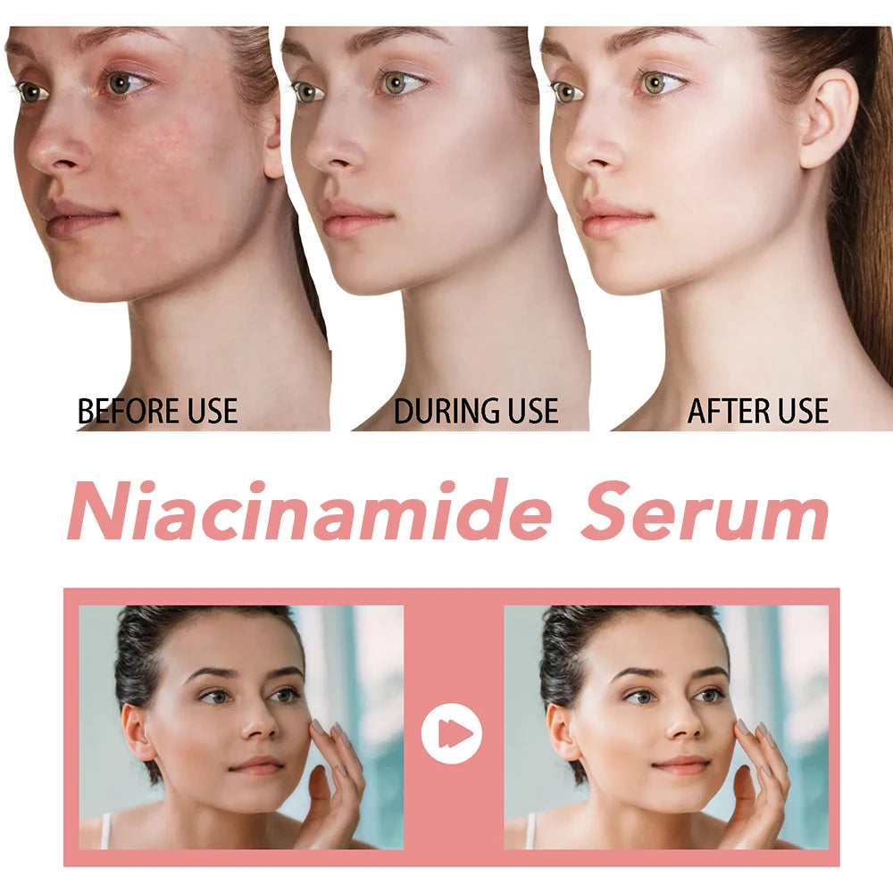 30ml Niacinamide Serum Melanin Removal Fade Melasma Dark Spots Corrector Shrink Pores Hyaluronic Acid Moisturizing Skin Care